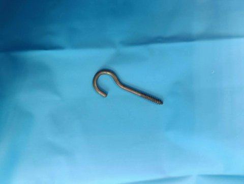 Nazinon : À 15 mois, elle survit après avoir avalé une pièce métallique